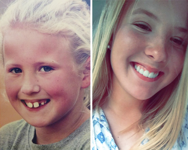 Zdroj: http://www.boredpanda.com/dental-braces-before-after/