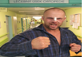 Bejrův zlomený nos