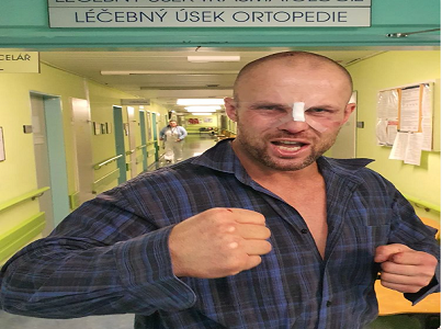 Bejrův zlomený nos